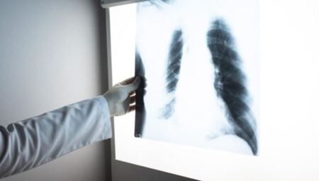 Uzmanı uyardı: Akciğer kanserinde erken teşhis ile tedavideki muvaffakiyet oranı artıyor